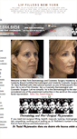 Mobile Screenshot of lipfillersnewyork.com
